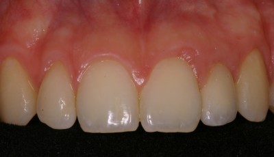 Implantat mit Krone Implantat mit Krone