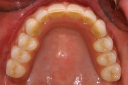 totalprotheseimoberkieferaufimplantatenohnegaumenabdeckungfrperfektengeschmackundsprache Oberkieferprothese auf Implantaten ohne Gaumenabdeckung