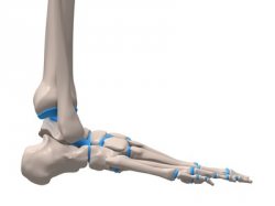 Arthrose Gelenkverschleiss, abgenutzte Knorpel