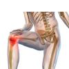Arthrose