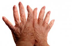 Arthritis Arthritis - ein rheumatische Erkrankung