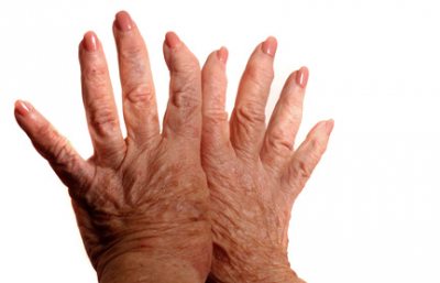 Arthritis