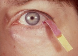 Trockenes Auge